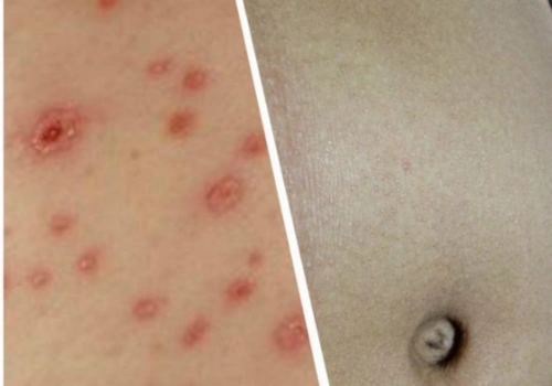 艾滋病舌部图片