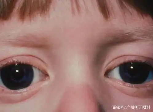 大眼萌娃,警惕儿童青光眼
