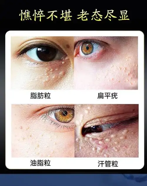脂肪粒草本祛眼部脂肪粒油脂粒汗管瘤眼霜膏黑眼圈袋眼部细纹眼部护理