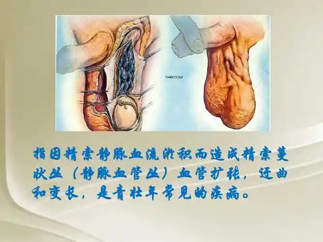 睾丸精索静脉曲张:病因症状及治疗.pptx_第3页