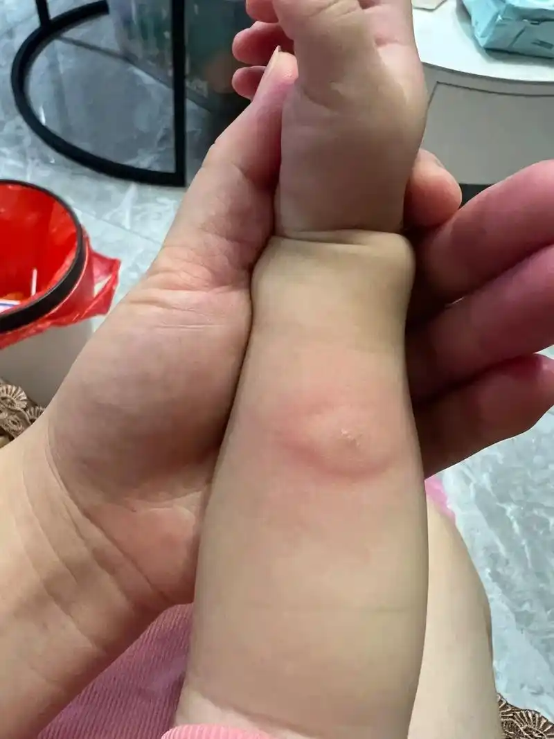 妹妹小手被蚊虫叮咬起了个大包,几天了还没消, 老二看了心疼