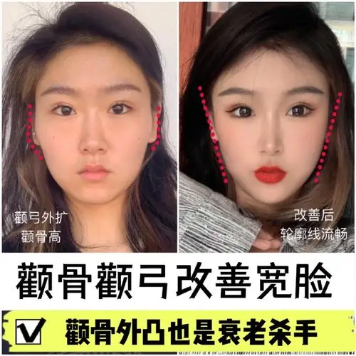 9696术前分析:可以看到小姑娘颧骨高,颧弓外扩,这样_圈子-新氧
