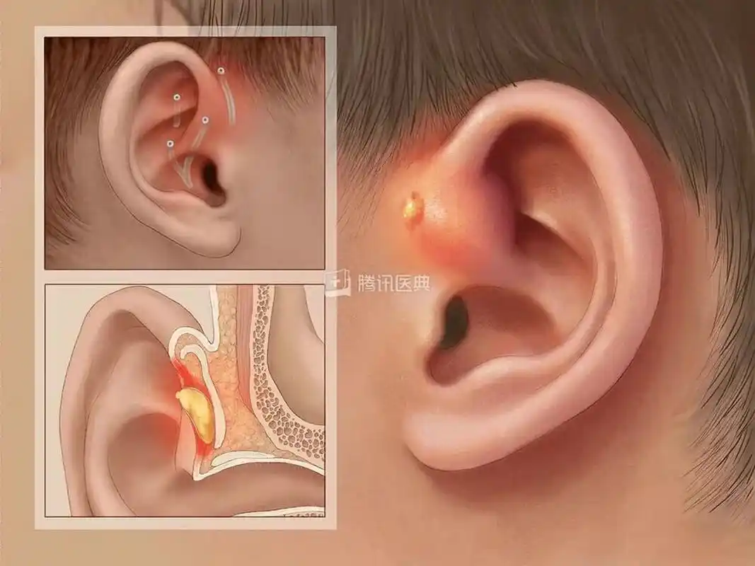 耳前瘘管趣事分享! 1.