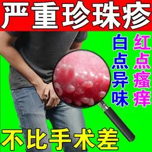 珍珠状丘疹阴茎珍珠疹专用喷剂男士冠状沟珍珠粒疹去除包皮炎药膏