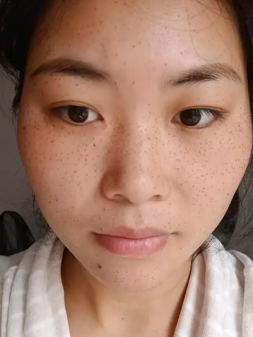 祛斑第四天,脸斑点还是很黑,期待效果