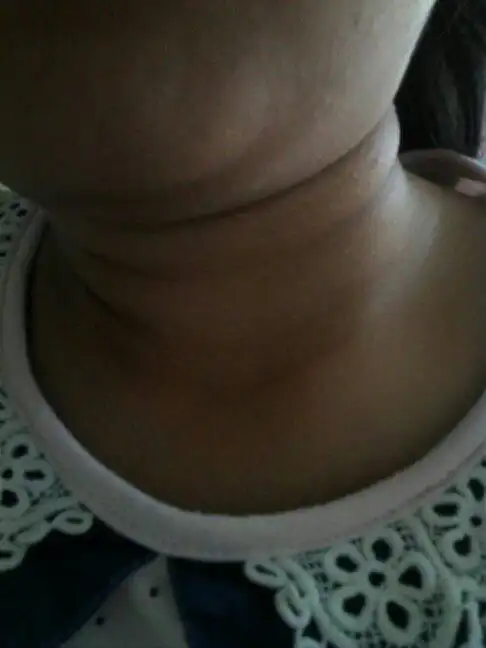 十三岁孩子的脖子 这是咋回事?