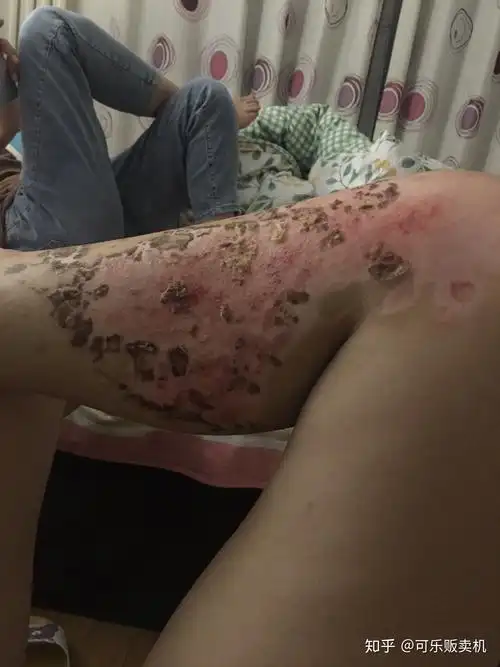 浅二度到深二度烧伤恢复过程记录有图慎点