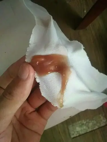 这种颜色的鼻涕是什么引起的