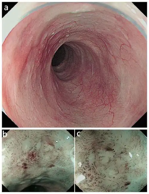 早期食管癌:内镜错误评估病例