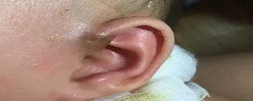 耳朵上有仓眼是怎么回事 爱问知识人