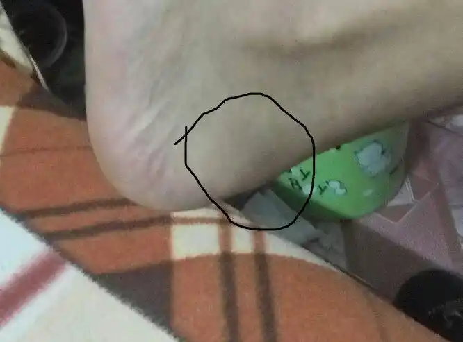 脚踝上有个包,有点痒,但不痛,怎么办