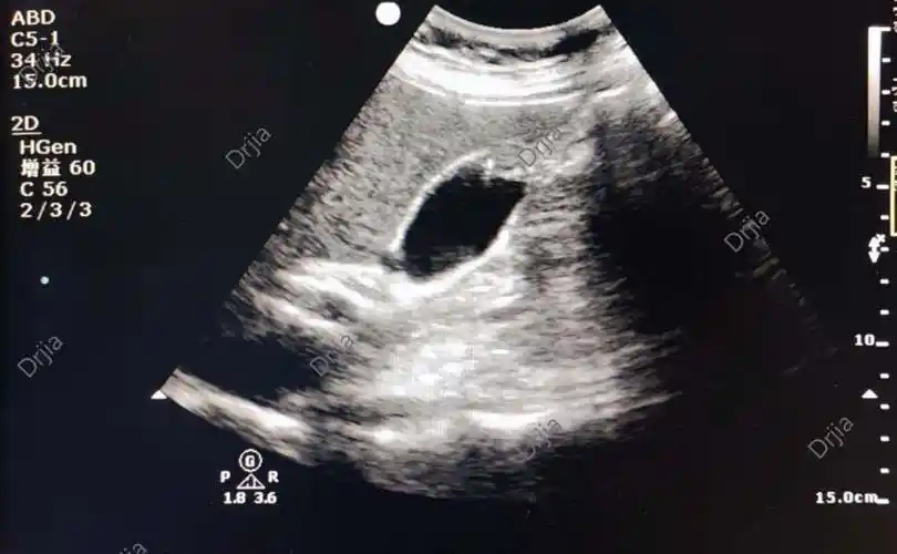 胆囊壁腺肌症一例分享