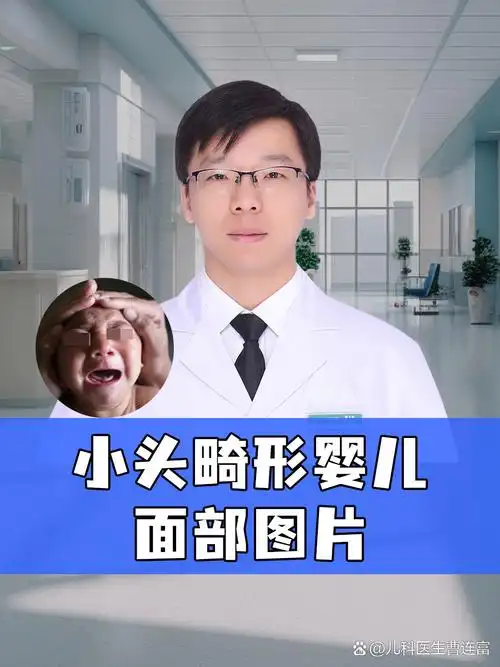 小头畸形婴儿面部图片  小头畸形是一种复杂的出生缺陷,主要表现为