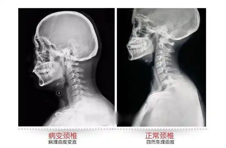 比如我就在前不久的体检中心查出颈椎反曲(也叫颈椎反弓),难怪这段