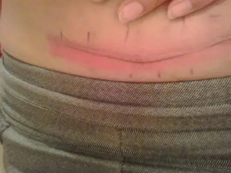 大家帮我看一下 这伤是 做什么手术留下的?