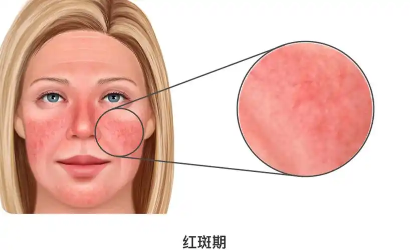 玫瑰痤疮是什么?有哪几个阶段?每个患者都会发展到最严重的阶段吗?