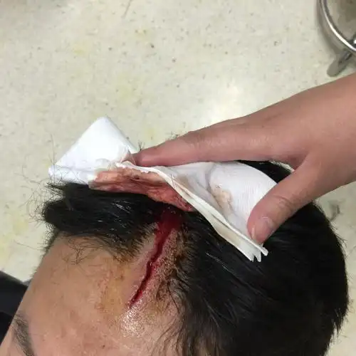 8厘米裂伤,深度露骨,算轻伤害吗?跪求法医大人给个正