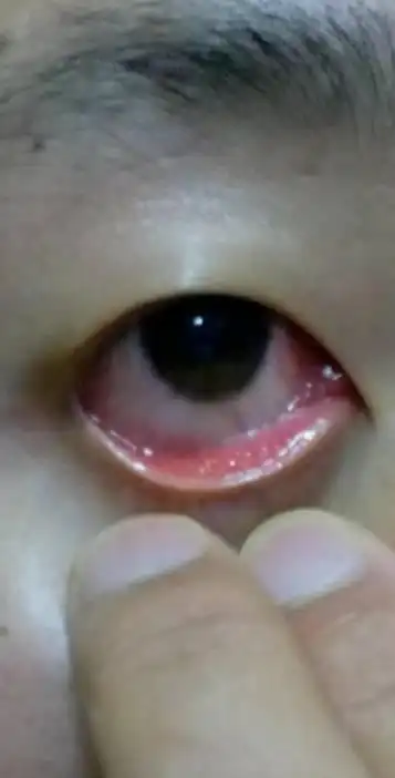 眼睛特别痒!花了很多钱逗看不好!