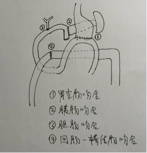 手术示意图成功完成这例高难度手术后,胃肠外科主任陈超也放下了心头