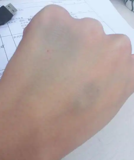 为什么伤口会产生乌青块