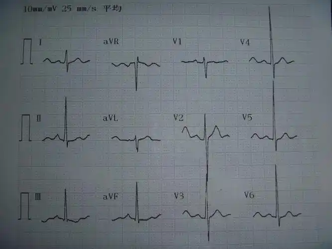 t波改变有异常,就要考虑是不是心脏的供血不足,这个情况往往和与