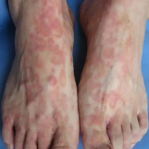 男梅毒初期图片40