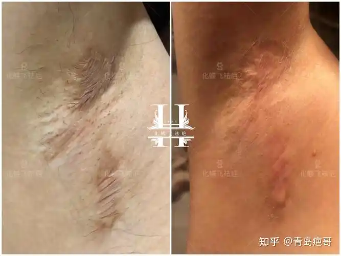 七八年的腋下手术疤痕