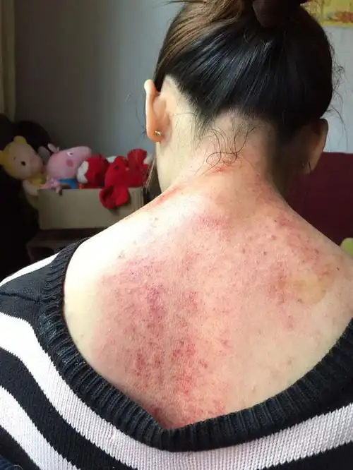 背上刮痧很红是怎么回事?