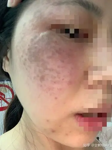 从幼儿园就有的褐青色痣在医院治疗全记录2020