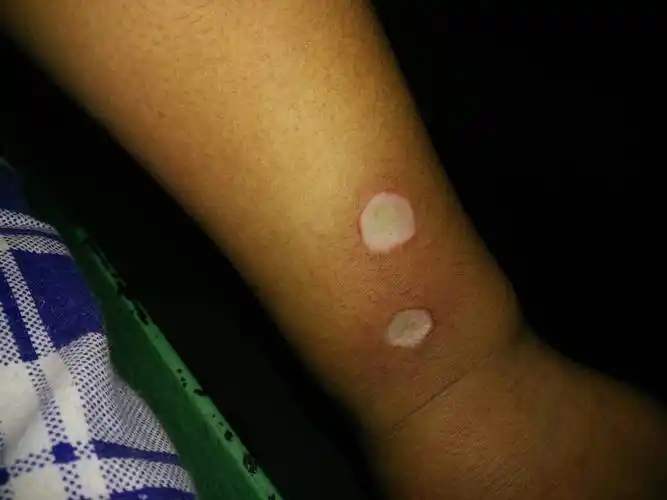 手上有两个烟疤,我学的是电工,以后当电工会不会有影响?