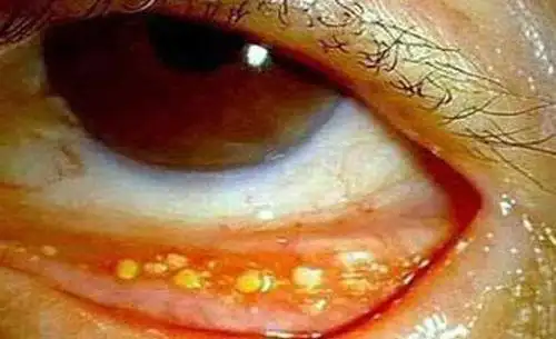 因熬夜经常追剧,她的眼睛已长满了结石