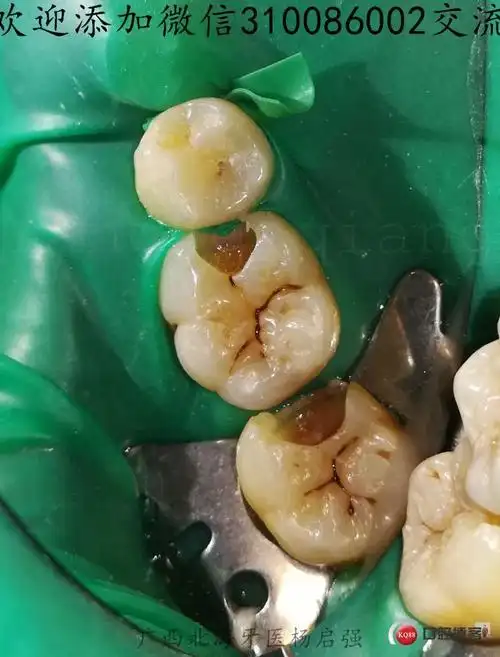 用牙胶尖做楔子,颊舌侧各一个根,塞紧,恢复面壁,把二类洞变成了一类洞