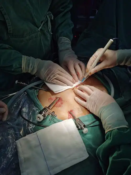 30上午主刀腹腔镜胃间质瘤切除术,下午张斌主任的两