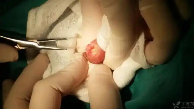 以前见过视频介绍,正好有个严重包茎,包皮粘连的孩子,极度不配合门诊