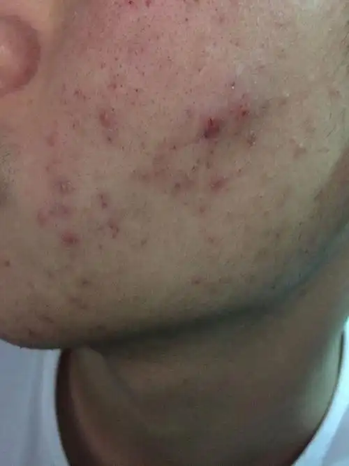 谁知道脸上脓包痘痘治疗调理有效方法,本人21岁这两年脸上平均痘痘