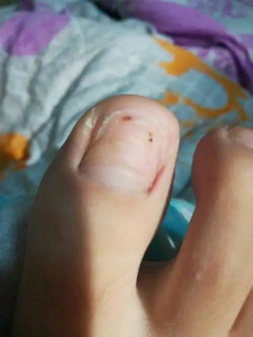 大脚趾甲掉了,现在用原来的指甲盖在上面,好吗