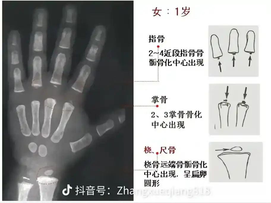 保存作品儿童骨龄,自己学习一下 - 抖音