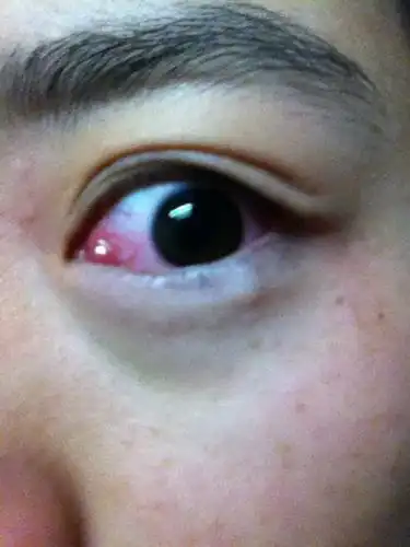 眼角红肿化脓 眼皮起包 痒痛