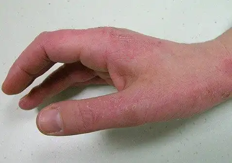 大人湿疹症状:丘疹大人湿疹症状:皮肤增厚或苔藓样变尽管存在其它类型