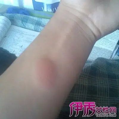 【肺结核皮试不正常图片】【图】肺结核皮试不正常图片大全 两大治疗