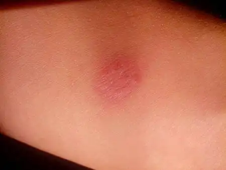 检查出来是弱阳性,然后前天又去医院做了ct拍了片子,然后检查结果还没