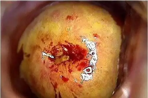 女性梅毒主要原因