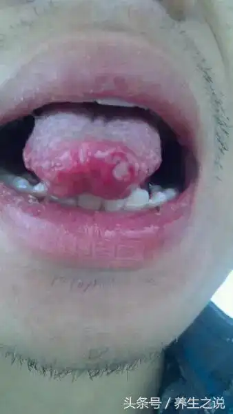 秋季上火,舌尖,舌根,舌边溃疡,喝三茶,降火消炎,身体更健康