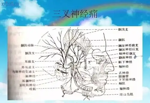 针刀如何治疗三叉神经痛