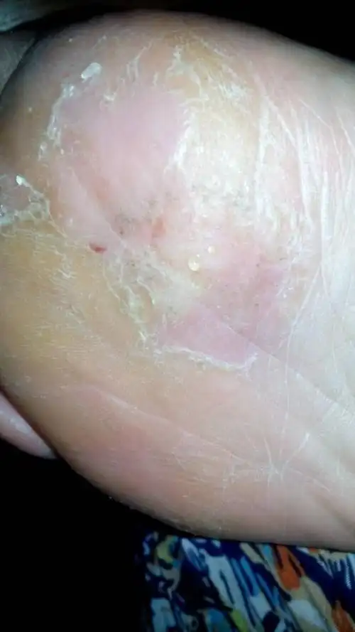 问:脚底皮肤变硬,里面显现小针眼式的水泡,过两天就流粘液,抹的达克宁