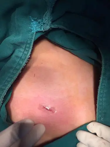 未成年人腹股沟疝的个体化规范化治疗