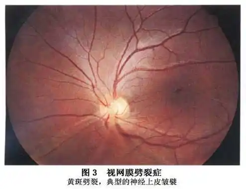 黄斑劈裂  劈裂症发生于黄斑部者称黄斑部视网膜劈裂(macular