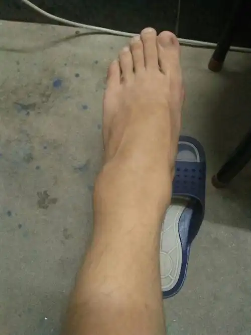 我去年脚腕扭伤过,肿了打包,当时去医院拍片子又说没什么事,,然后我就