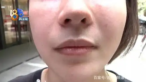 鼻子术后有些歪,修复费用怎么付