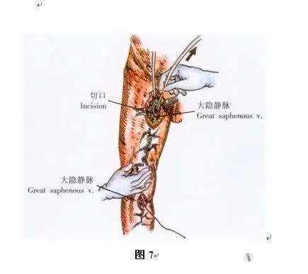 大隐静脉高位结扎分段结扎术